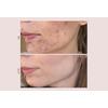 Pudderdåserne T-Zone Peeling - 50 ml.